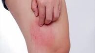 کهیر پوستی چیست و چگونه درمان میشود ؟