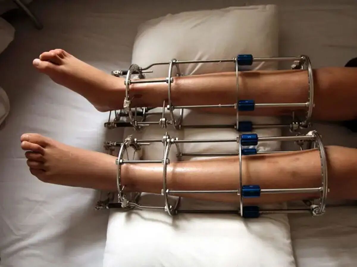 جراحی افزایش قد و هر آنچه باید راجب این جراحی بدانید!