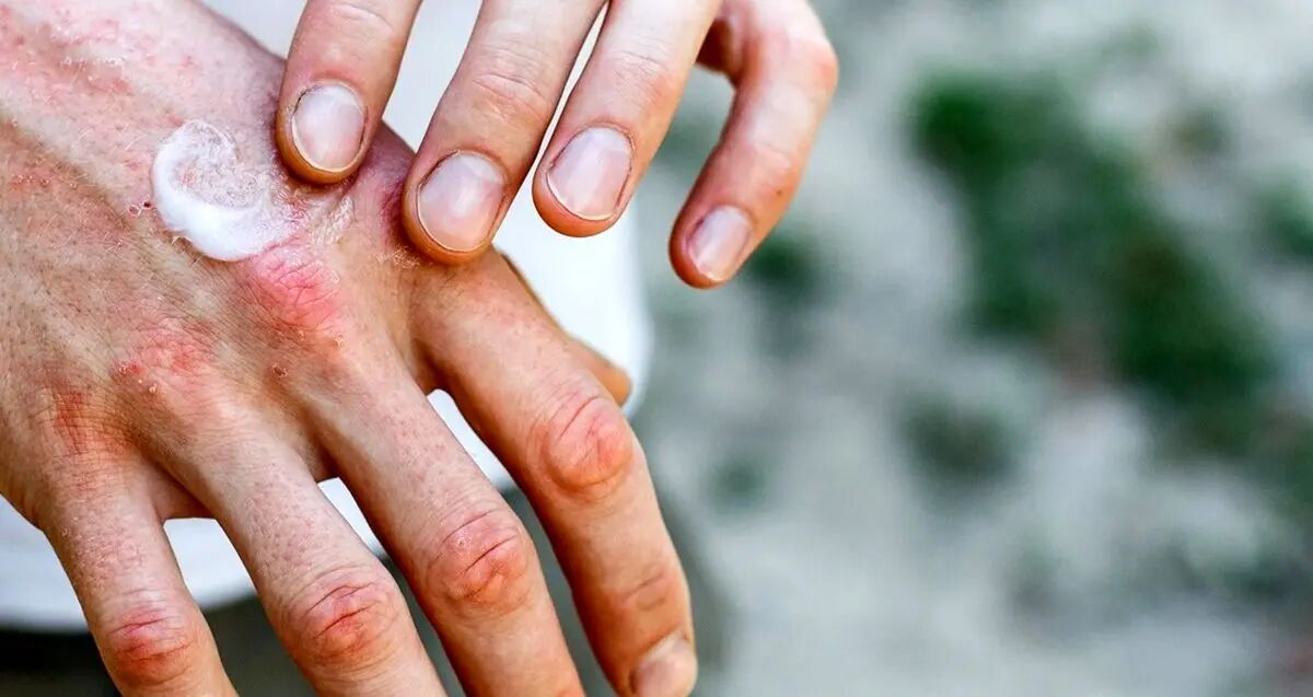 علت پوست پوست شدن اطراف ناخن و روش های درمان