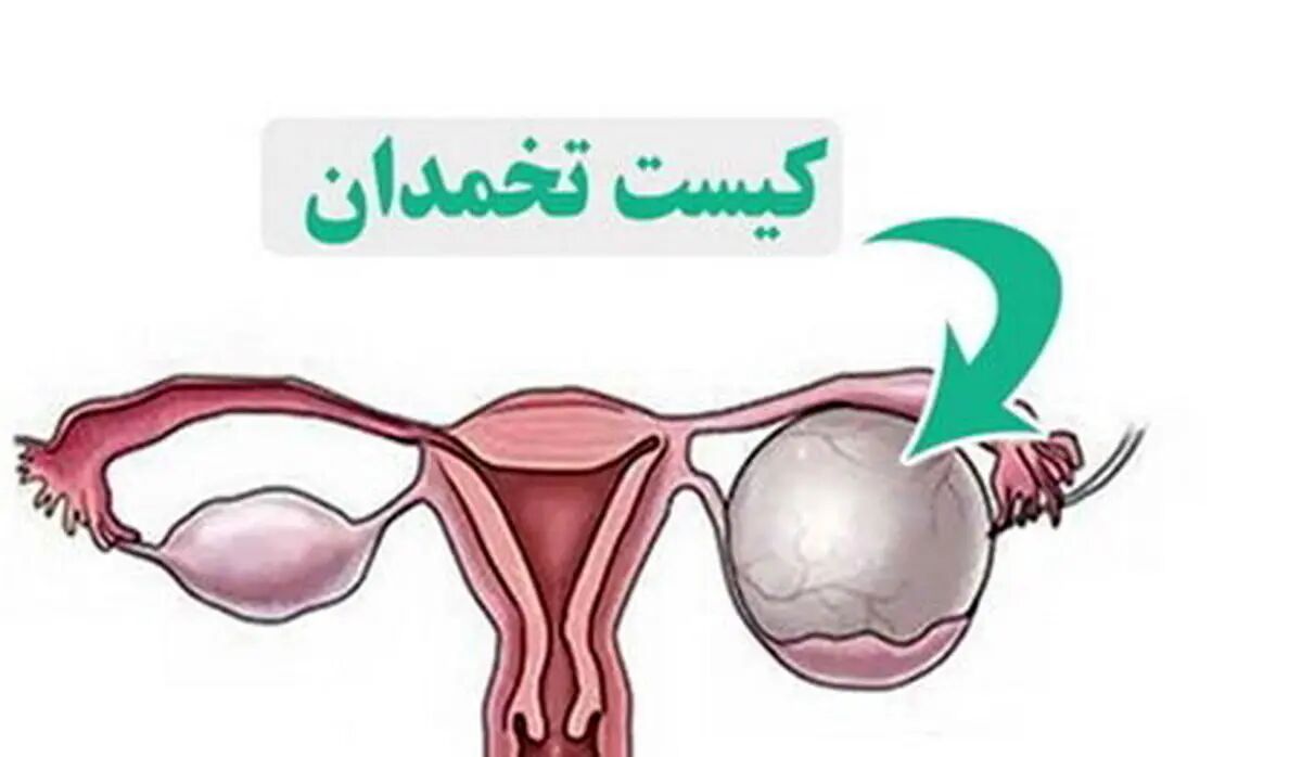 کیست تخمدان؛ مشکل شایع اما اغلب بی‌خطر در زنان