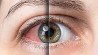 چگونه از خشکی چشم در هوای سرد زمستان پیشگیری کنیم؟