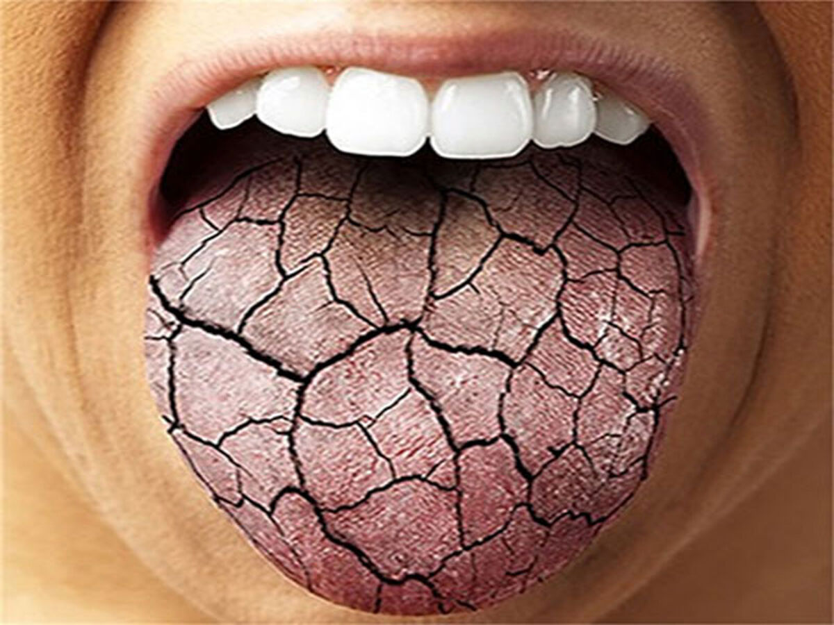 علت خشکی دهان چیست؟