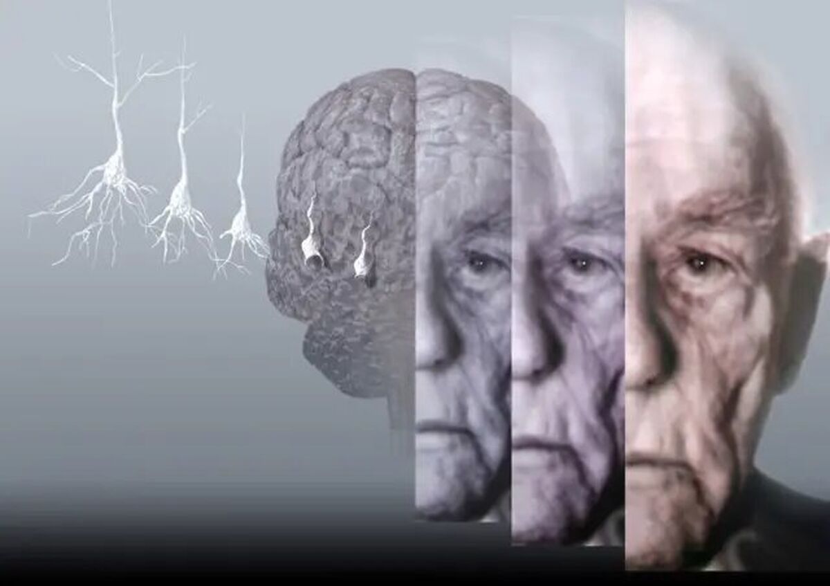 ۷ عادت مفید در پیشگیری از آلزایمر