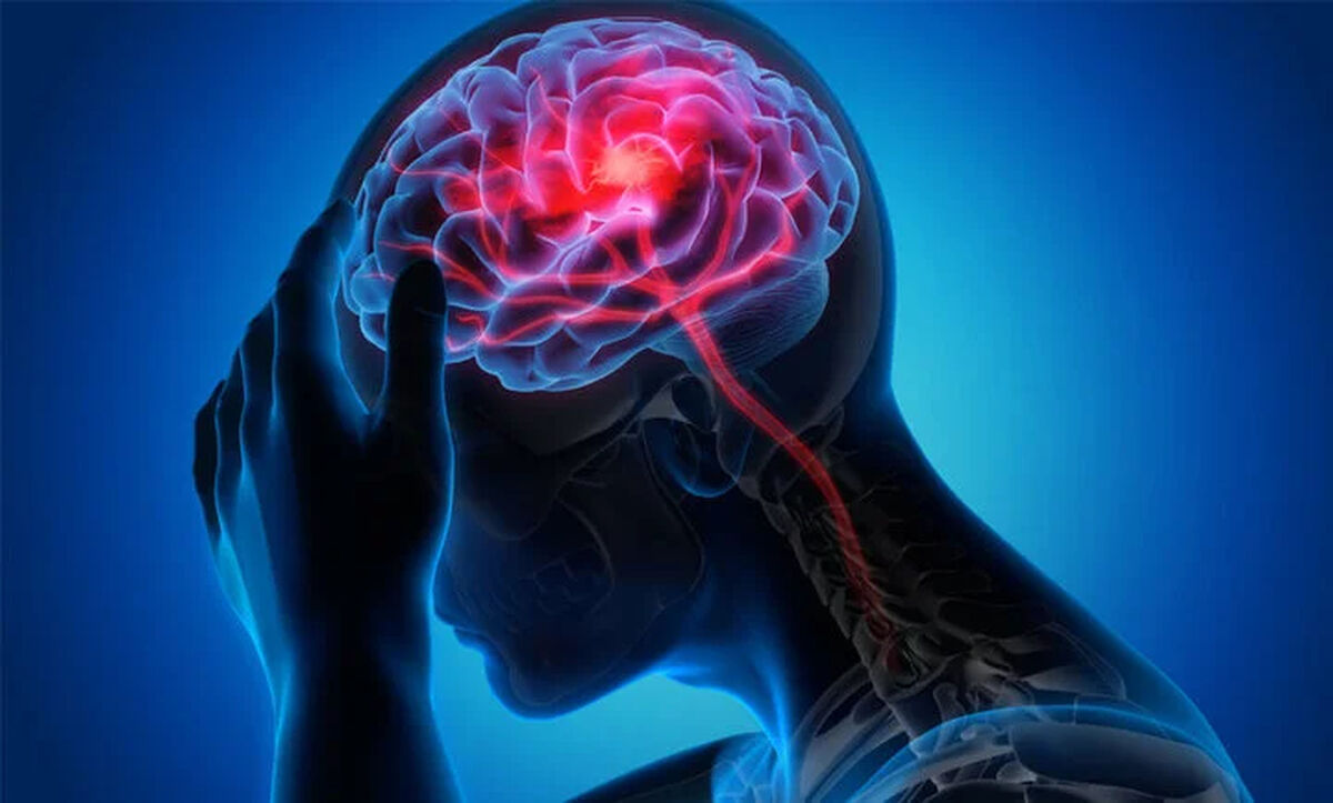 تحریک نخاع به بازیابی قدرت بازو پس از سکته مغزی کمک می کند